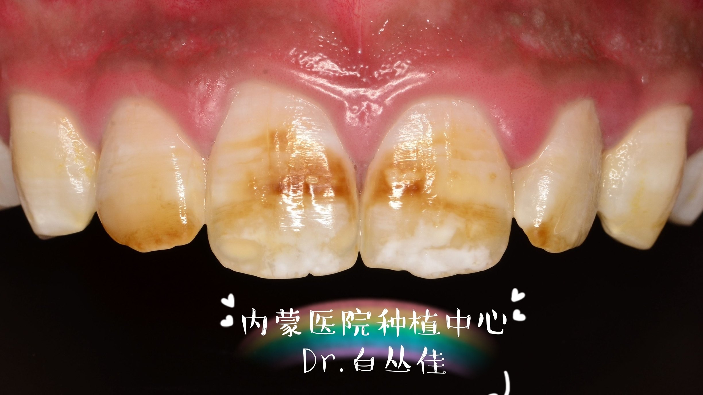 氟斑牙漂白治疗三年随访一例