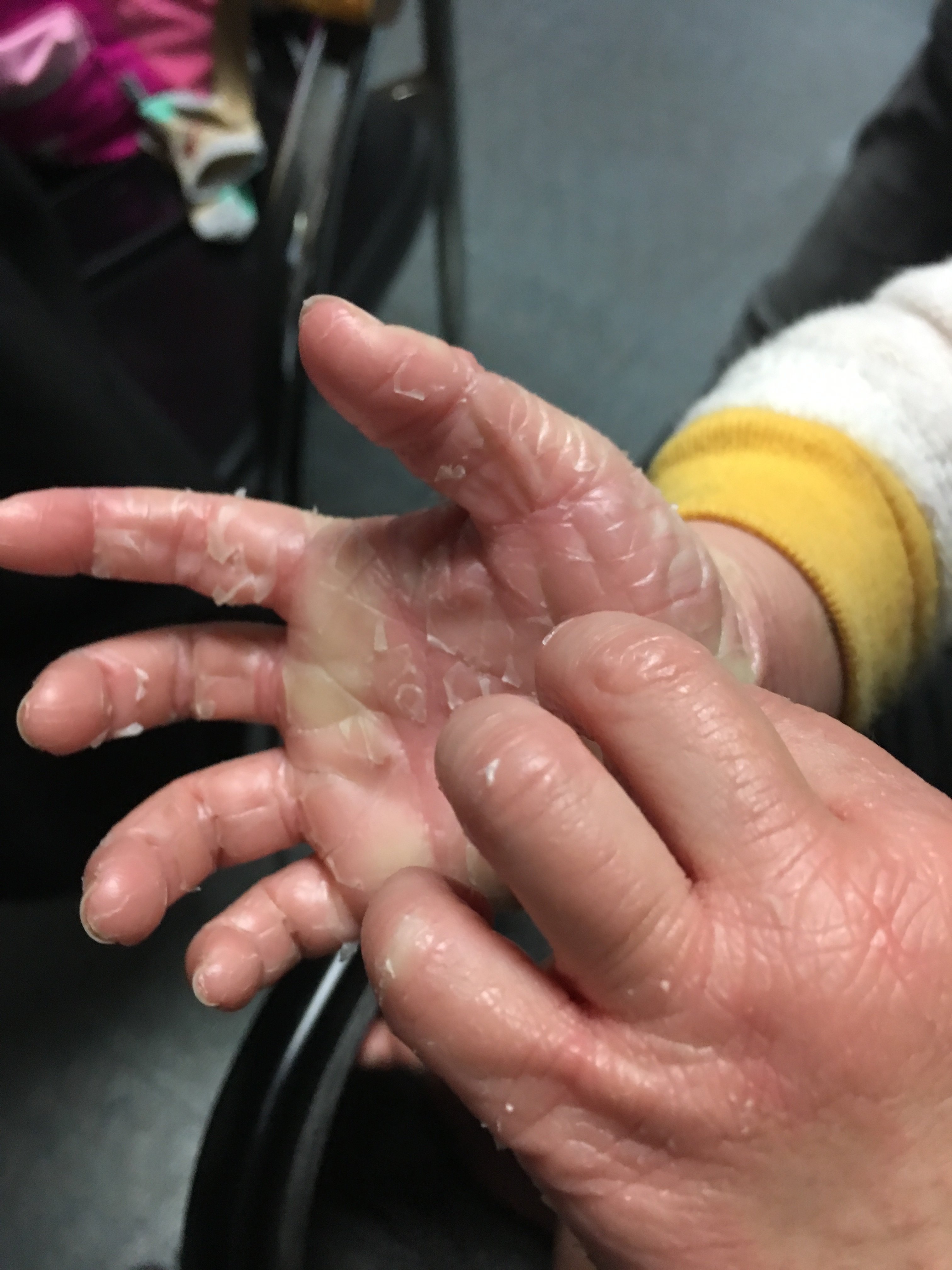 毛发红糠疹成因,诊断,治疗及预后_皮肤病_皮肤病相关疾病 - 好大夫