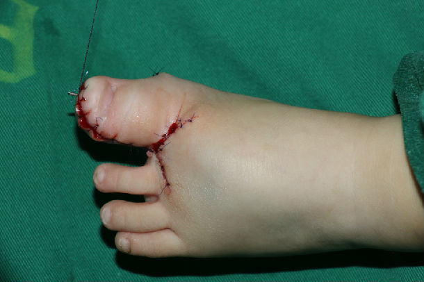 巨趾畸形的一点浅体会 - 好大夫在线