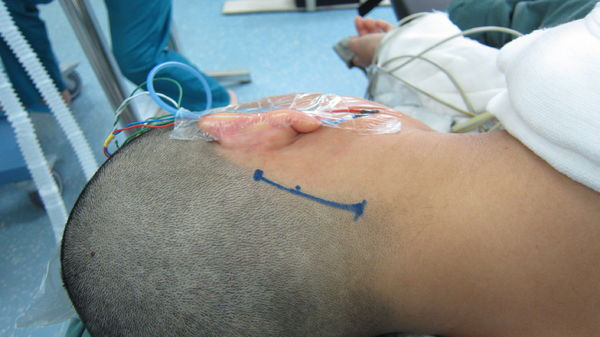 图解显微血管减压手术治疗三叉神经痛的过程