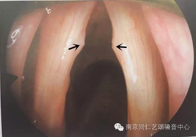 嗓音常见疾病——声带小结的诊断与治疗 - 好大夫在线