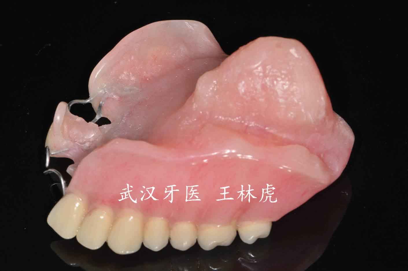 因而许多口腔颌面部缺损仍需采用人工材料的赝复体进行修复