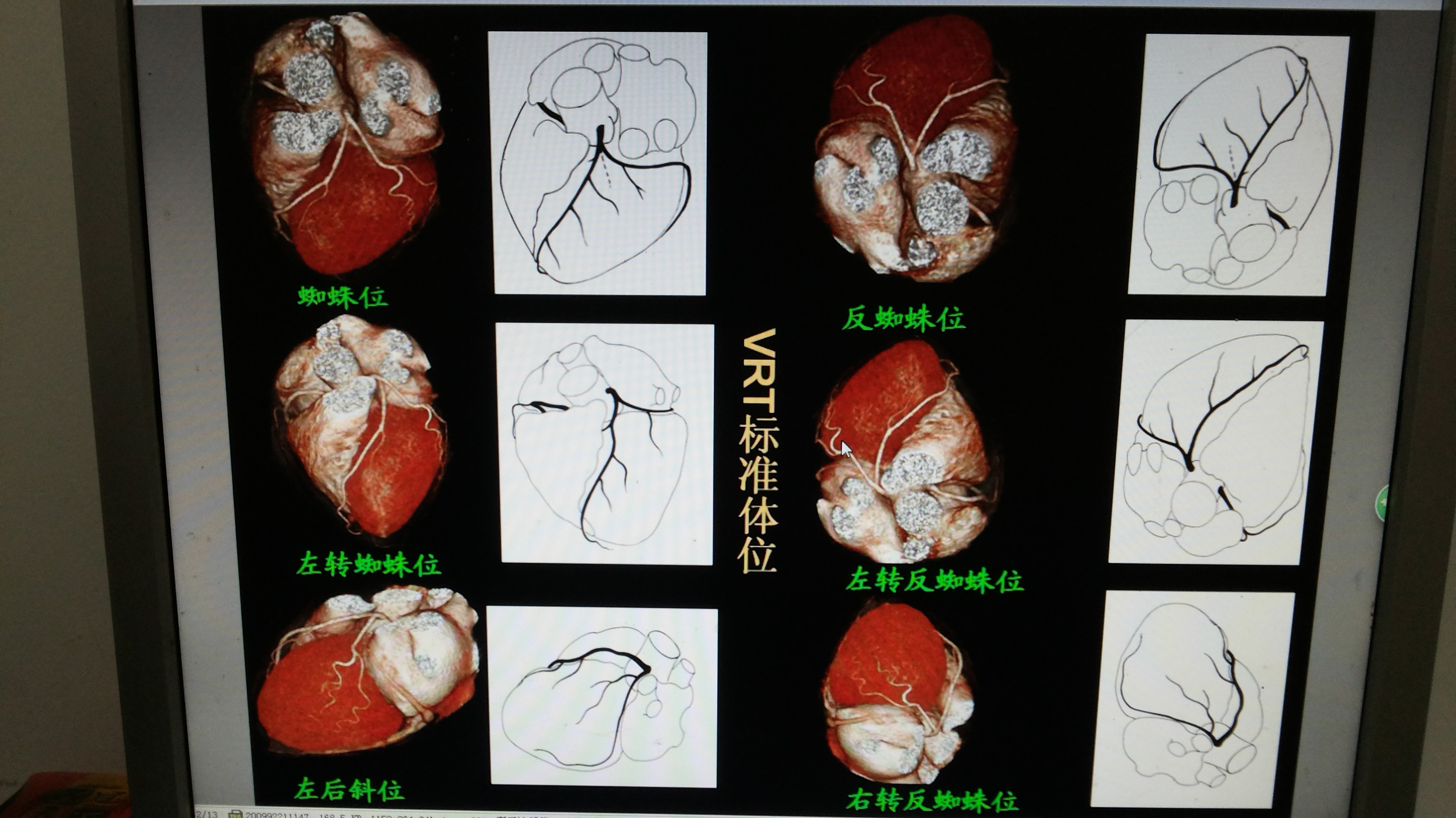 心臟冠脈左支體位 - 好大夫在線