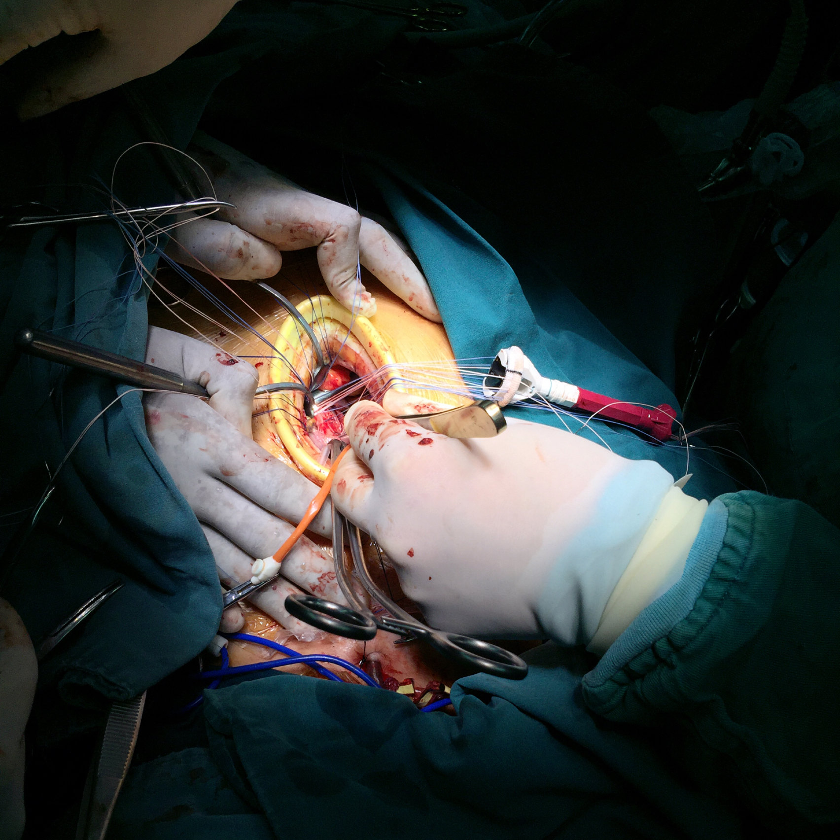 微创技术实施主动脉瓣置换 二尖瓣置换