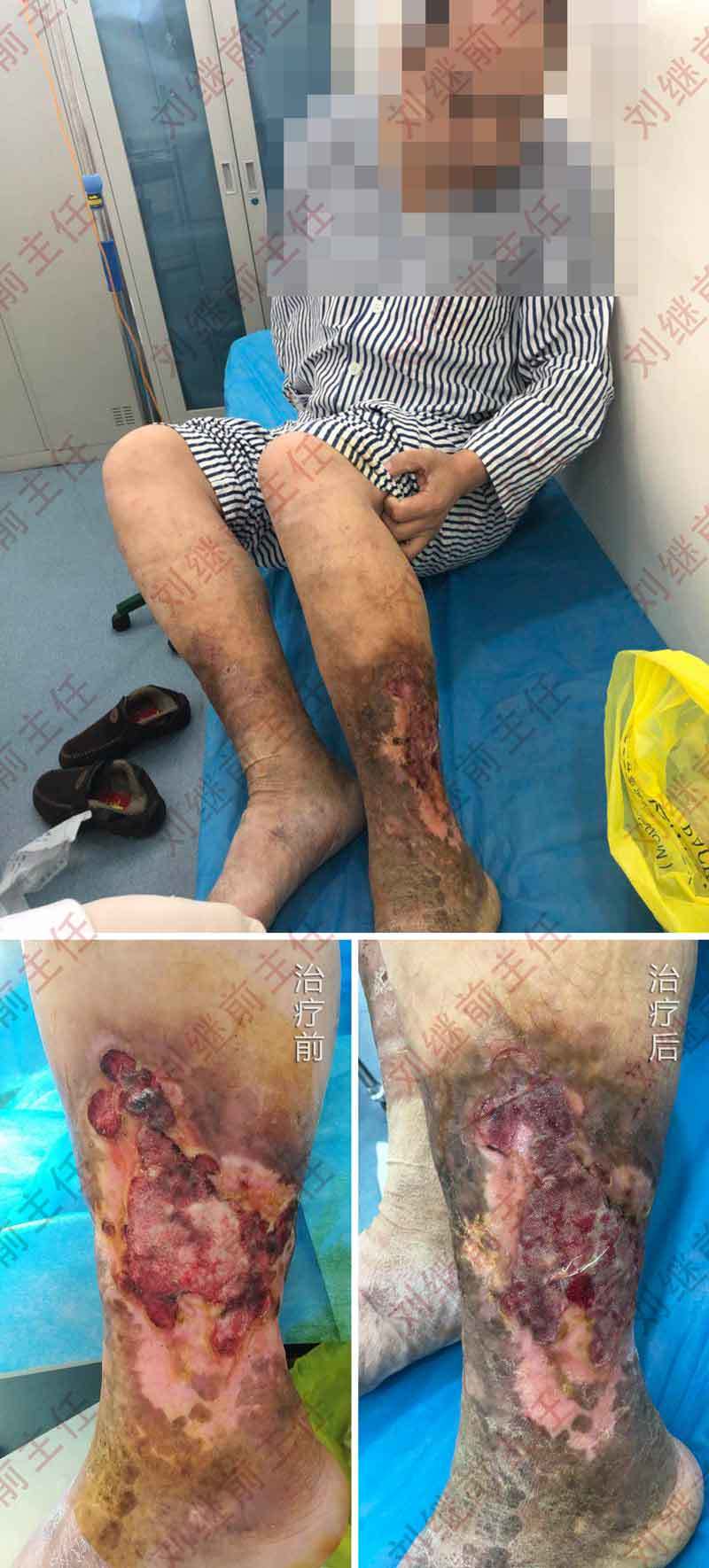 老烂腿患者住院治疗几天前后对比