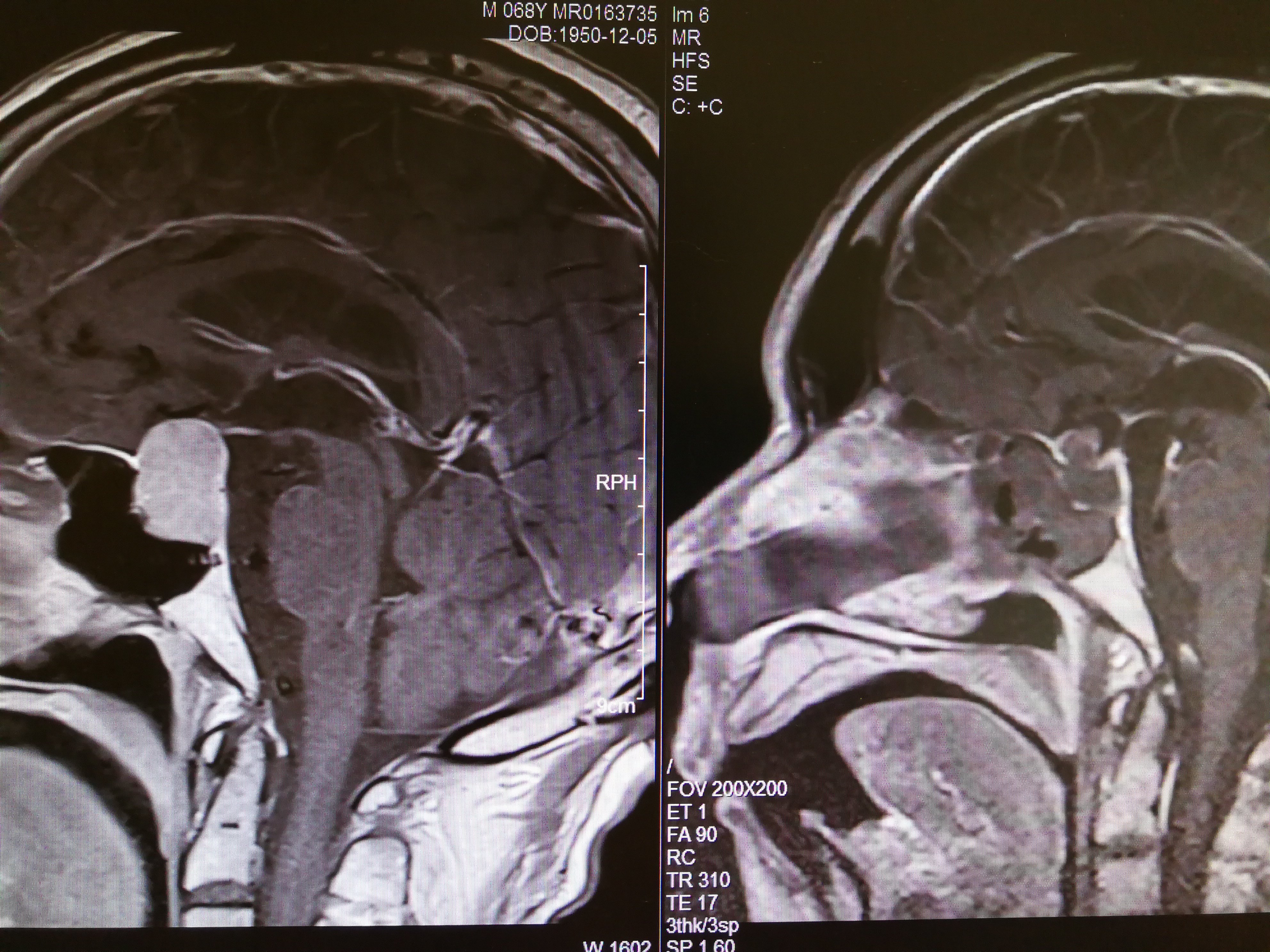 术后(右)核磁共振片,手术效果满意,病人恢复得也很好,希望垂体瘤患者