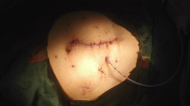 巨大低位腹壁切口疝腹腔镜无张力修补术(杂交技术)一例 