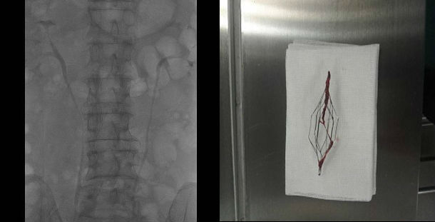 深静脉血栓放置下腔静脉滤器