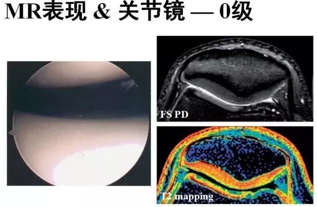 髌骨软化核磁共振图像图片