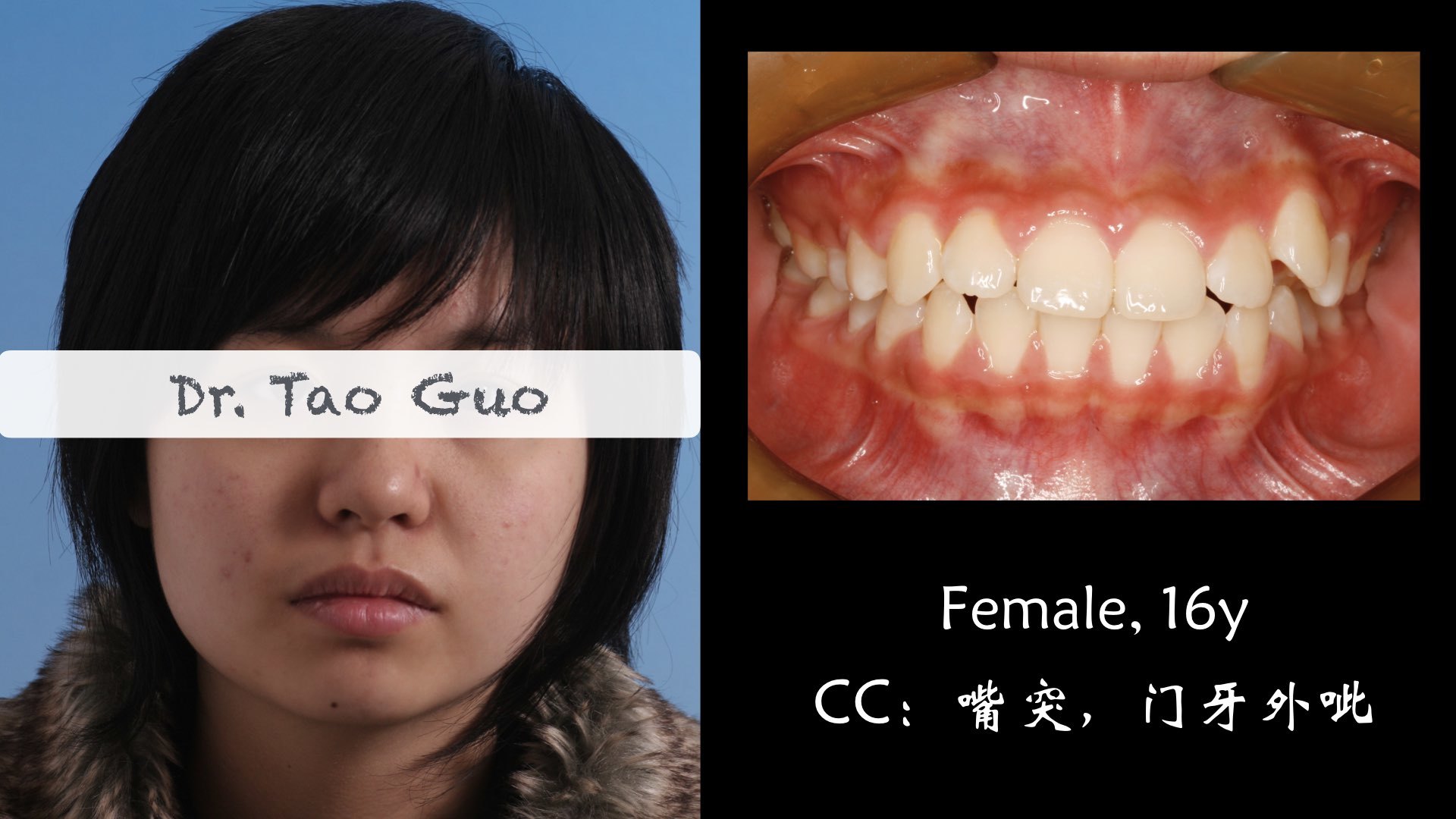 青少年龅牙,嘴突矫正案例 - 好大夫在线