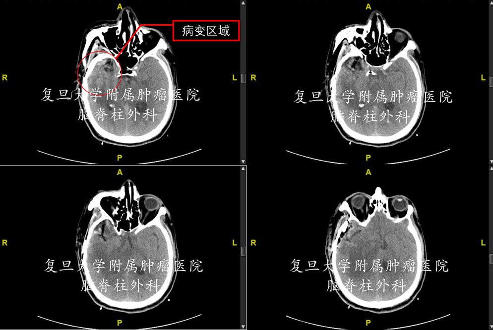 成功治療腦膠質瘤一例 - 好大夫在線