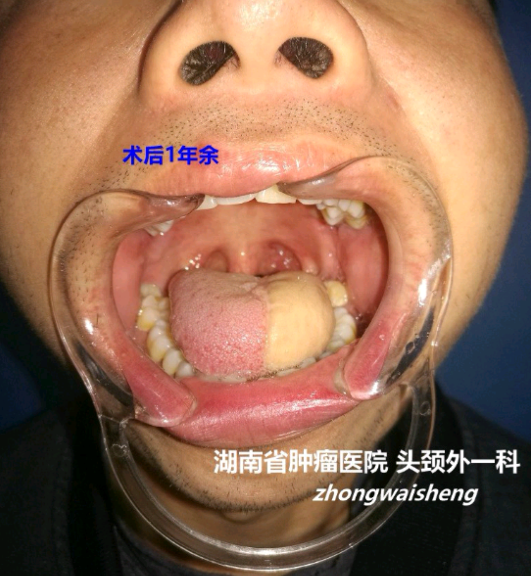 舌癌手术图片