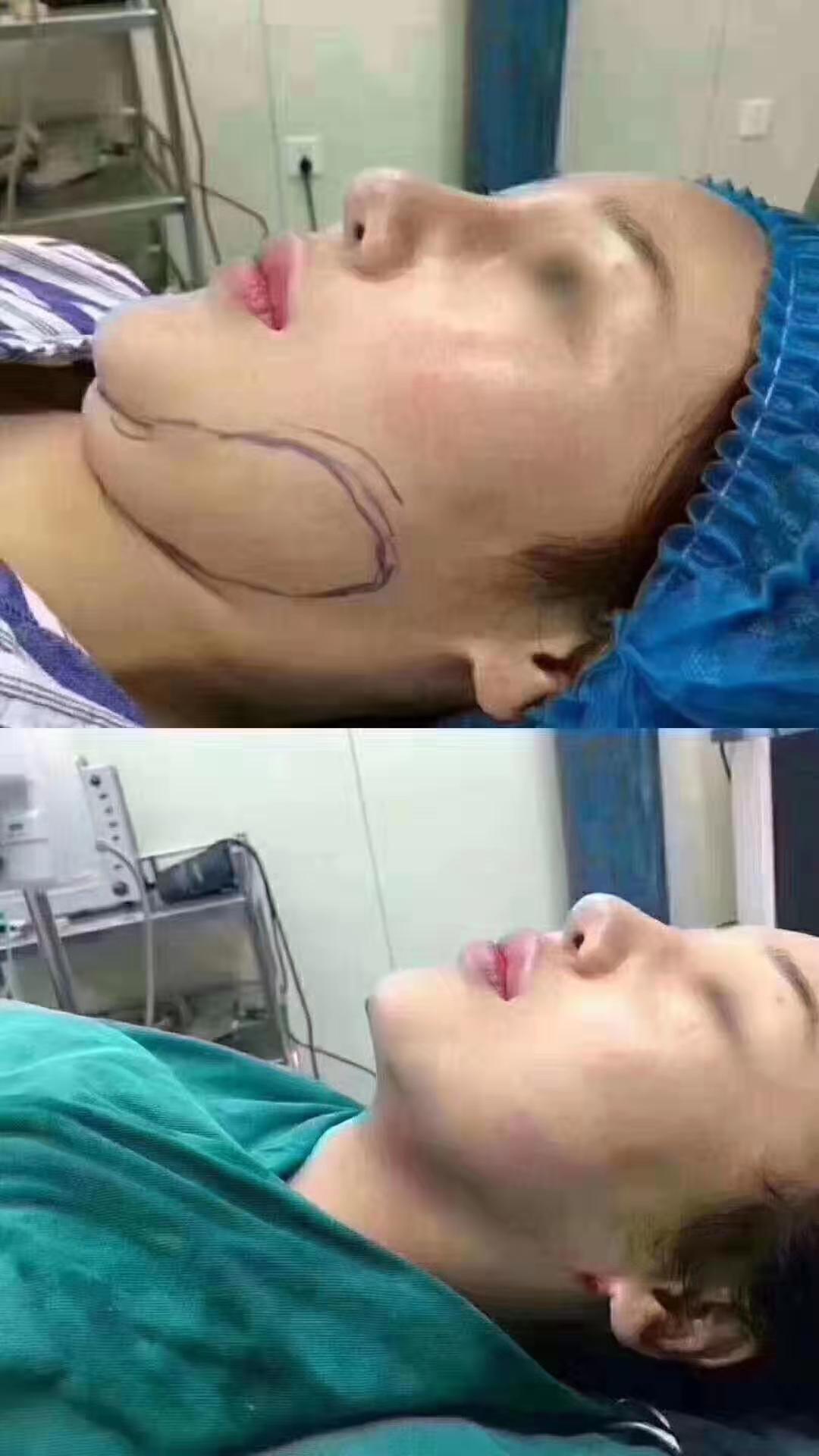 哪些人适合做面部吸脂手术? - 好大夫在线