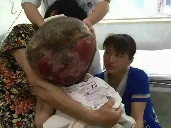 大头娃娃换头手术成功