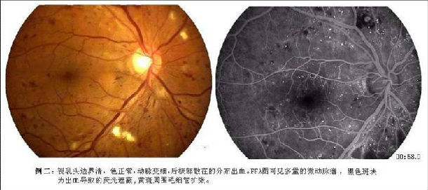 得了糖尿病性視網膜病變怎麼辦?