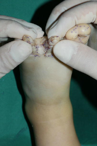 显微外科皮瓣在并趾分趾中的应用