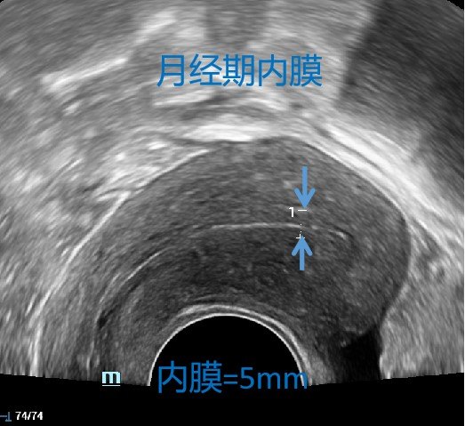 宫腔线清晰图片