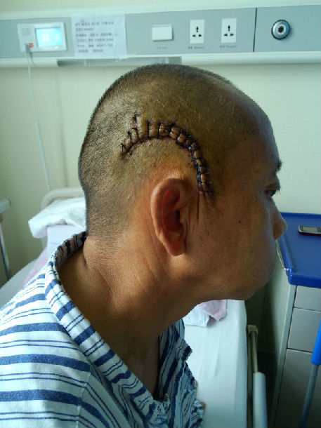 颞下岩前入路kawase入路切除中颅窝岩尖胆脂瘤