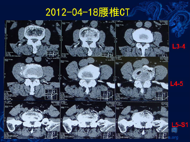 术前腰椎ct提示腰4