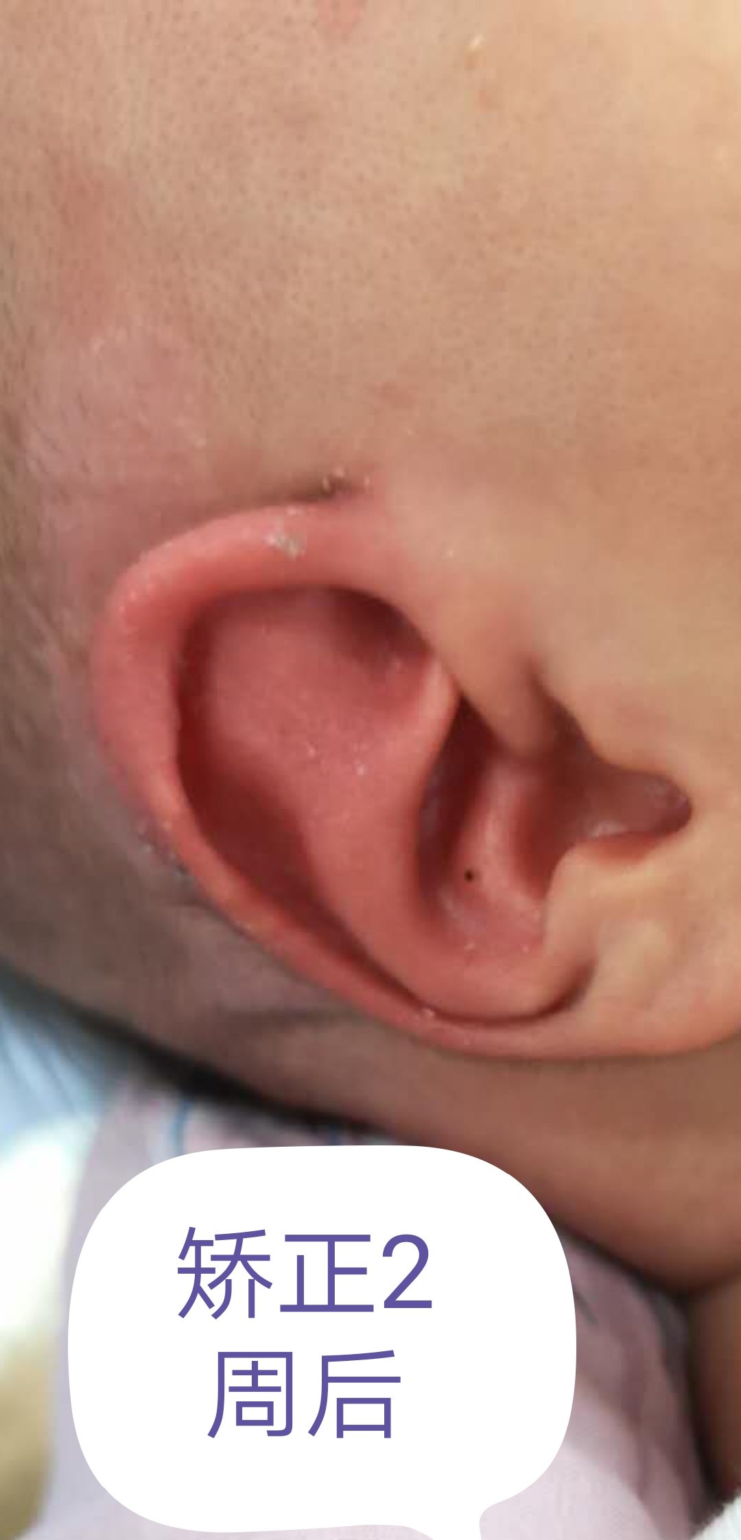 新生儿耳廓畸形,得早干预!