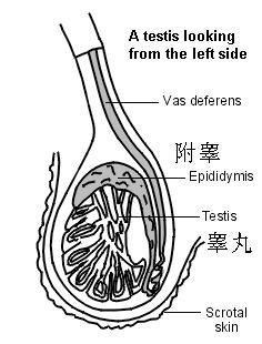 附睾囊肿epididymal cyst