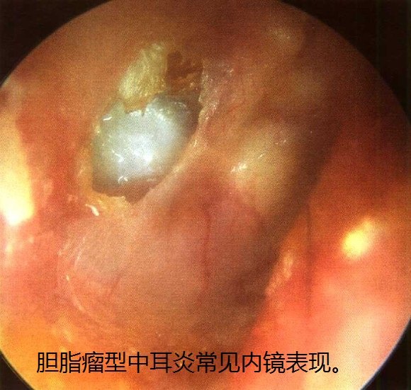 1.患耳流脓(有时没有明显脓液流出但有外耳道瘙痒).