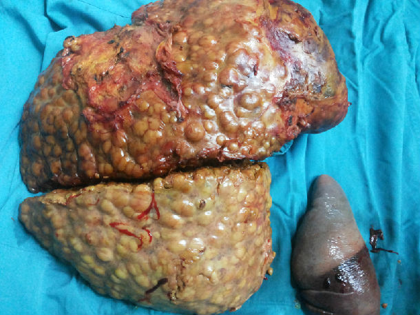 肝癌病人的肝脏图片图片