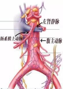 女性左肾静脉胡桃夹图片