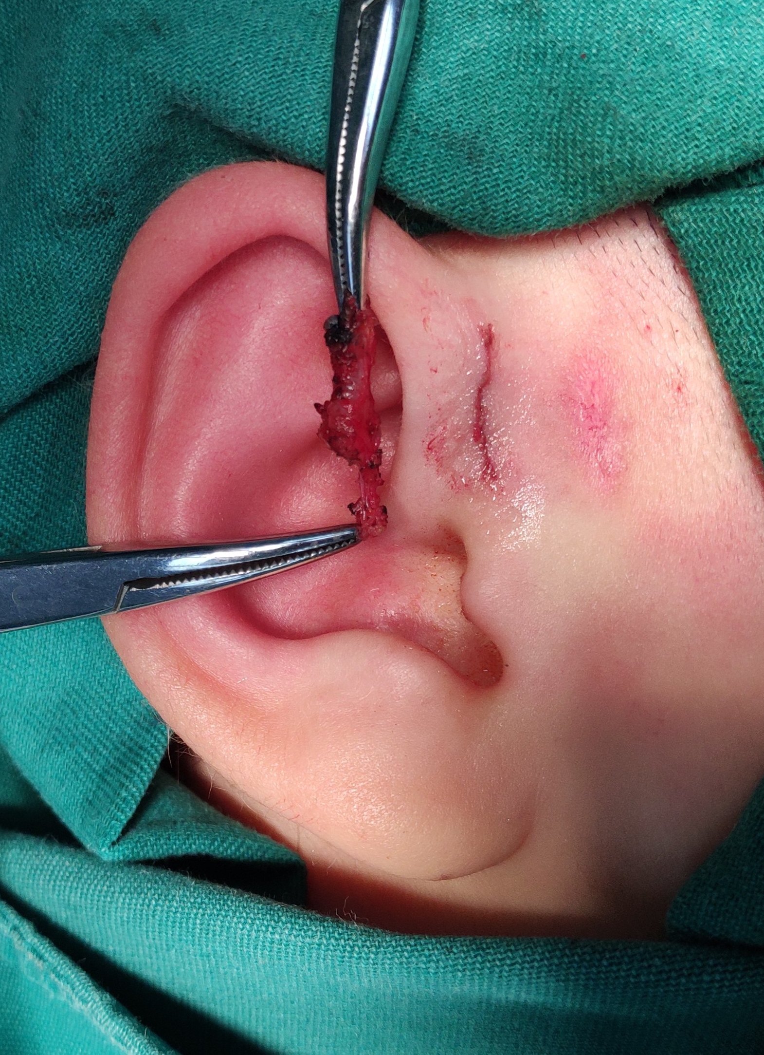 耳前瘘开口在耳轮小腿前)先天性耳前瘘管如何治疗?