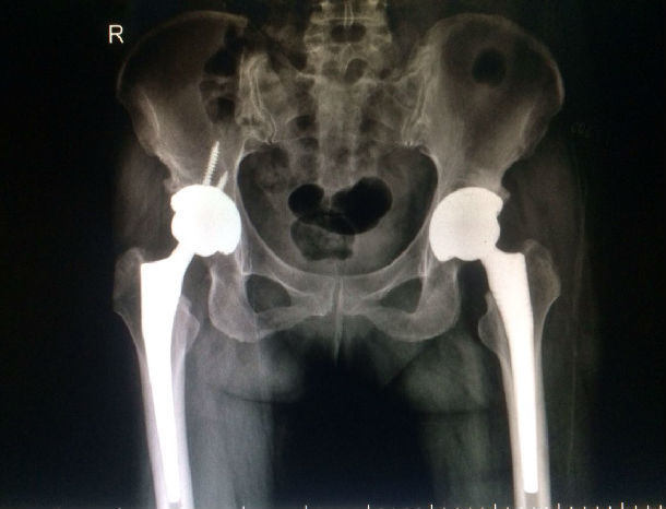 我院开展国产人工陶瓷全髋关节置换术 - 好大夫在线
