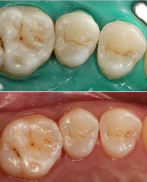 深龋充填后的注意事项_龋齿_治疗方法_治疗方式 - 好大夫在线