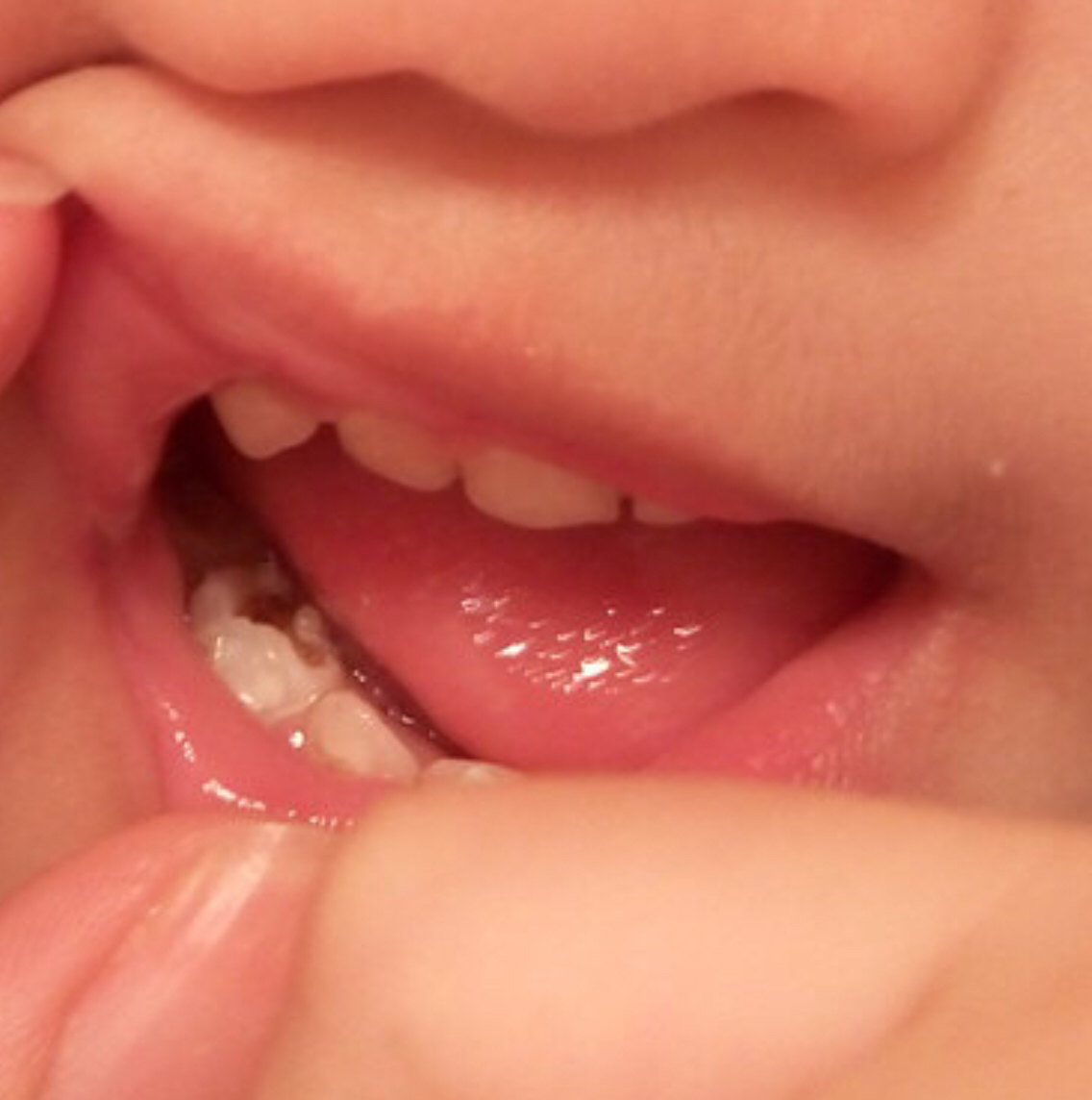 乳牙有必要窝沟封闭吗?该什么时候做?