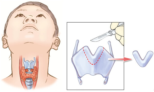 喉結縮小手術_整形 - 好大夫在線