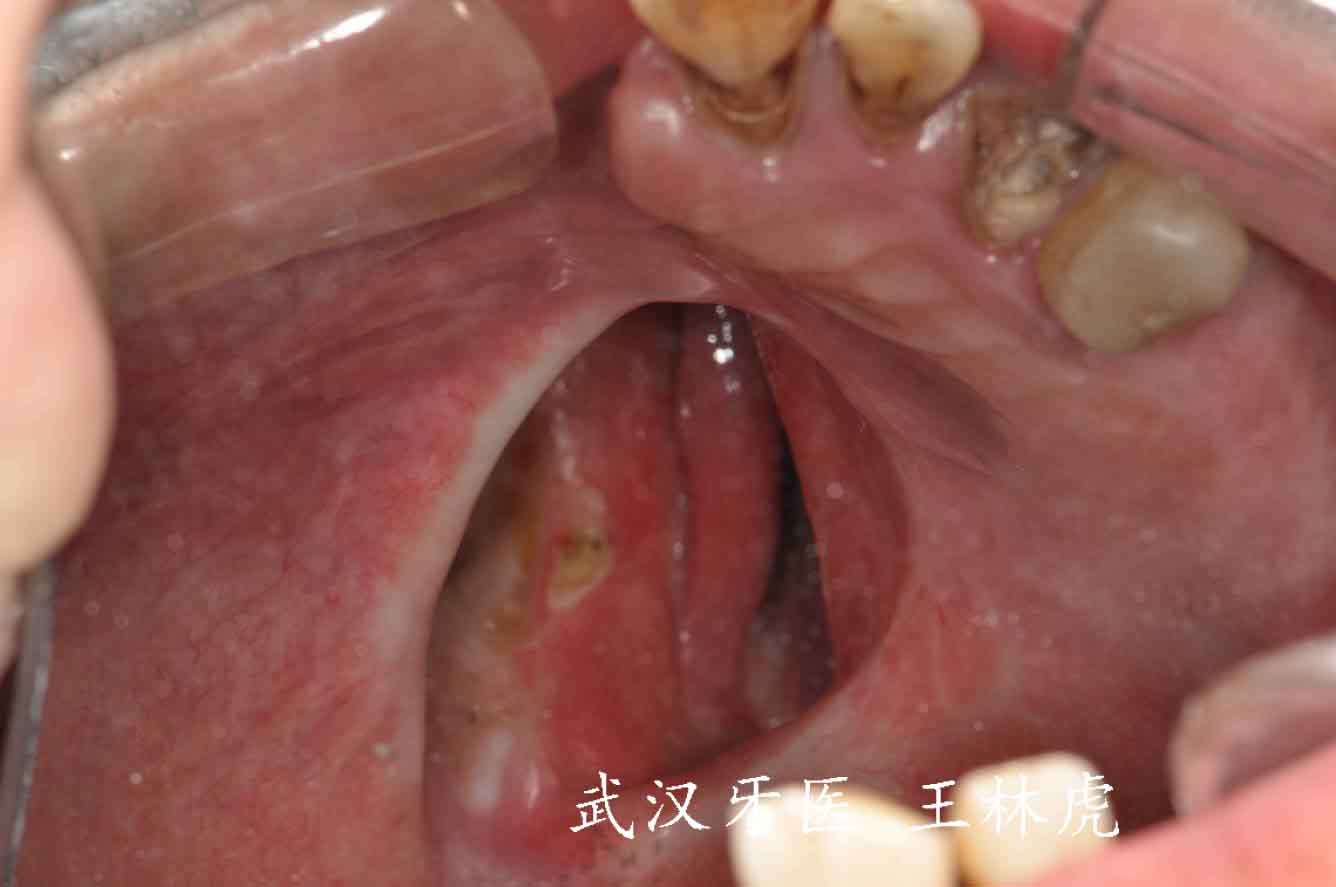 口腔内壁迷脂症图片