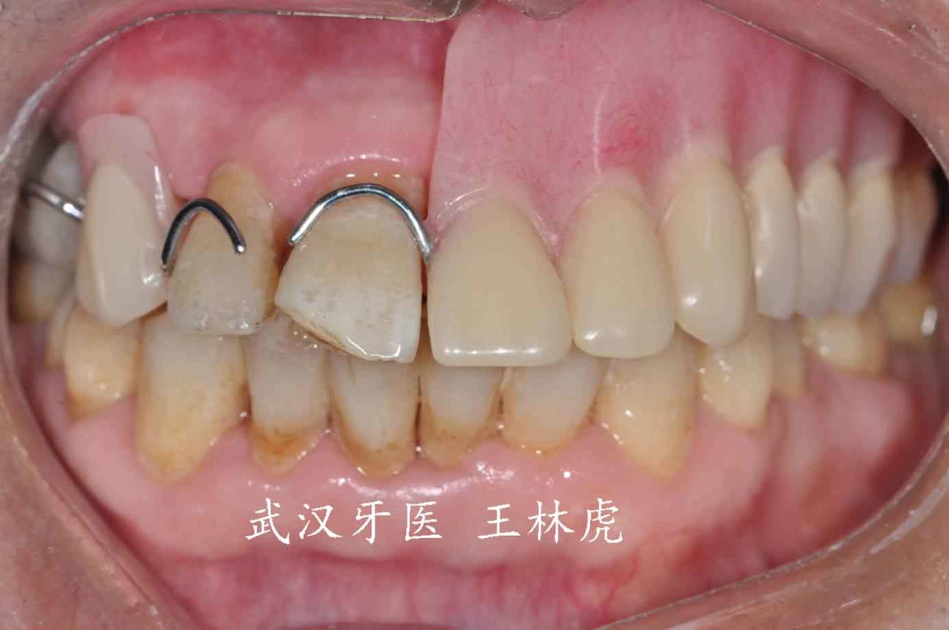 因而许多口腔颌面部缺损仍需采用人工材料的赝复体进行修复