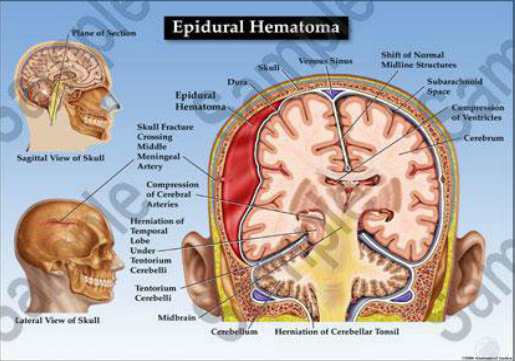 硬脑膜外血肿解剖图片