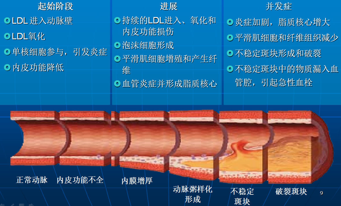 动脉硬化形成的原因图片