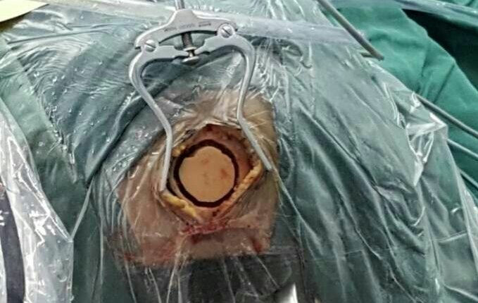 神经内镜手术治疗脑血肿