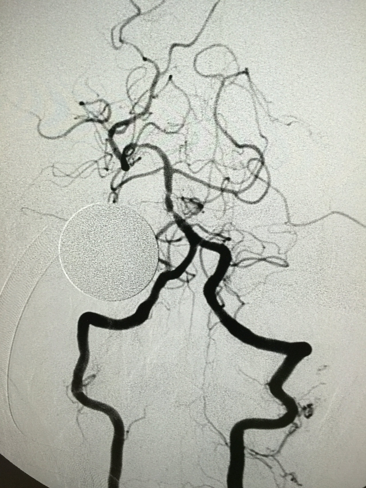 支架植入治疗基底动脉狭窄