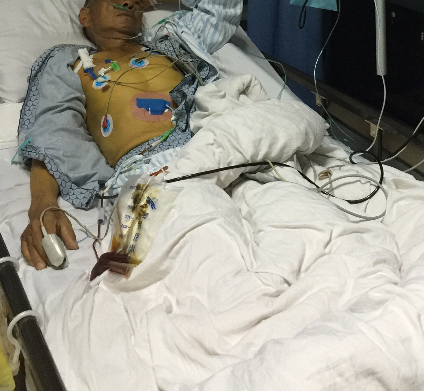 胆管梗阻黄疸肿瘤晚期放不了ercp支架怎么办? - 好大夫在线