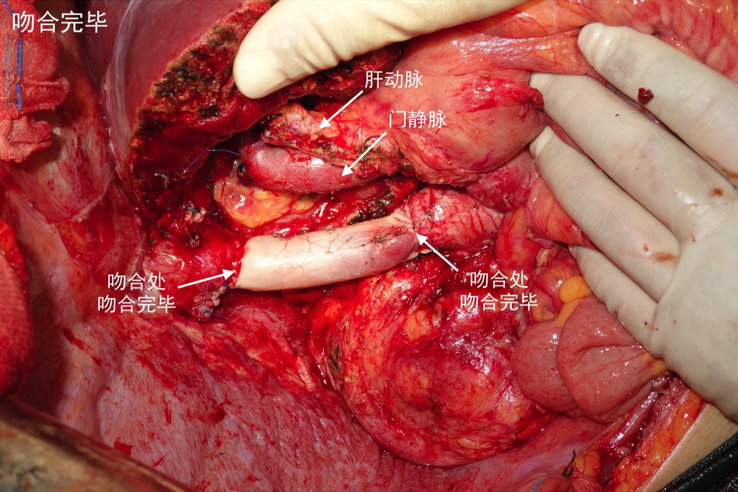 巨大尾状叶肝细胞肝癌切除术1例