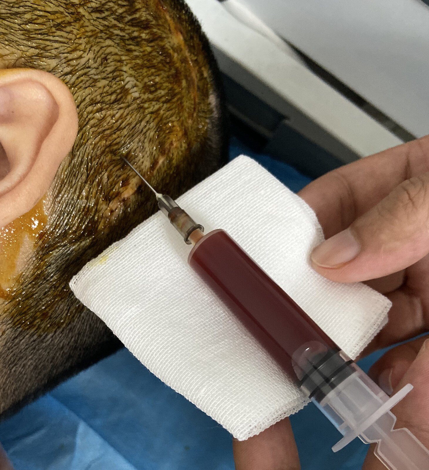 婴幼儿癫痫术后皮下积液怎么办?