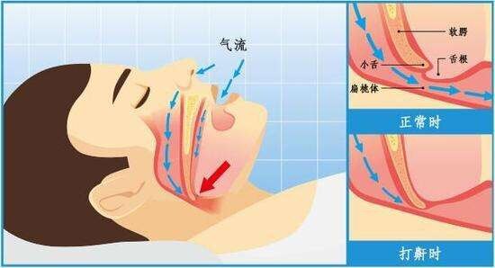 肥胖人群容易出现睡眠呼吸暂停_睡眠呼吸暂停综合征_发病原因_症状