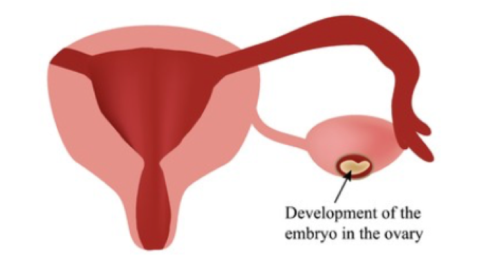 宫外孕一定要开腹手术吗 宫外孕 宫外孕 宫外孕一定要开腹手术吗 宫外孕 宫外孕