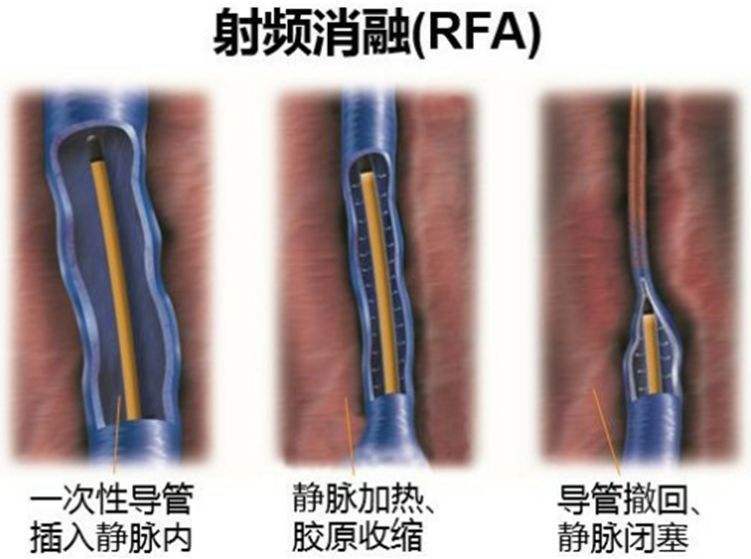 大隐静脉射频消融术.jpg