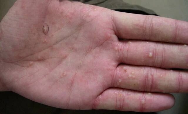 汗疱疹2020_汗疱疹_发病原因_症状表现_治疗方式_日常注意事项 - 好