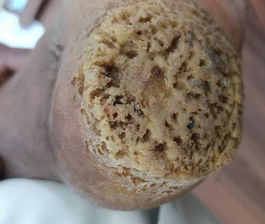 窝状角质松解症