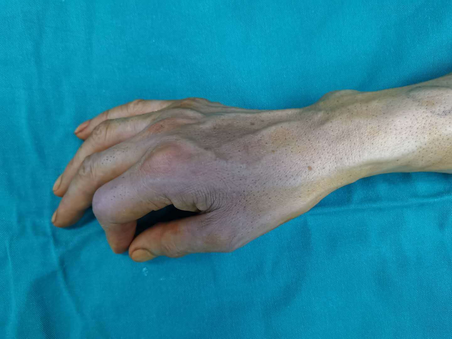 伸指肌腱中央束断裂-手术修复 - 好大夫在线