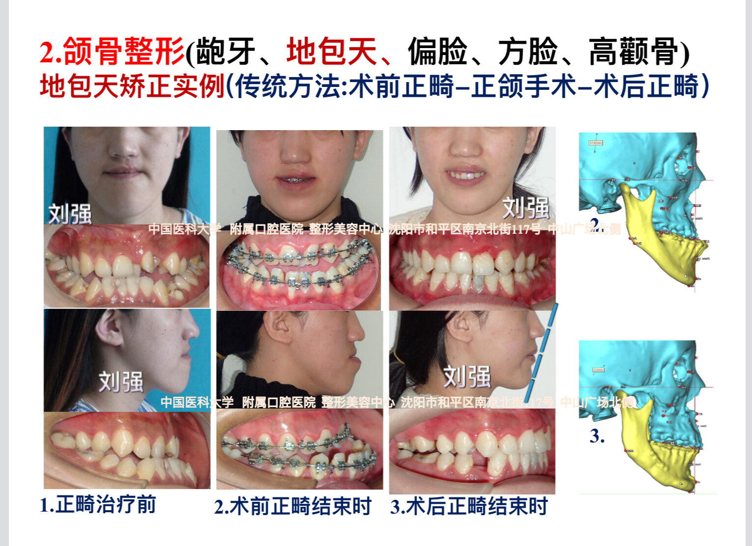 地包天整形案例分享2