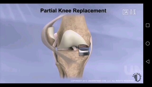 膝关节置换 示意图图片